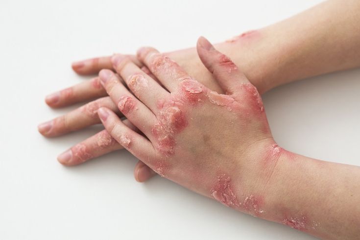Psoriasis in Ayurveda